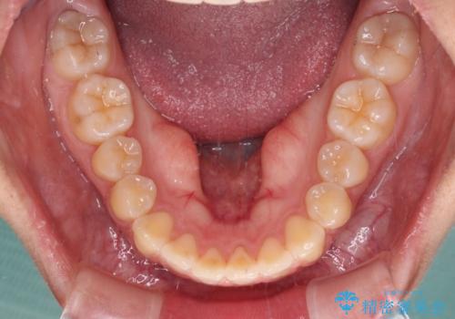 カリエール・ディスタライザーとインビザラインを用いた奥歯の咬み合わせ改善の治療後