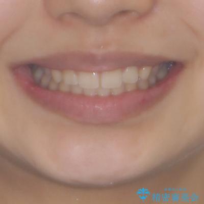 カリエール・ディスタライザーとインビザラインを用いた奥歯の咬み合わせ改善の治療後(顔貌)