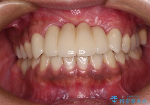 事故で抜歯となった前歯　ブリッジやインプラントによる補綴治療の治療後