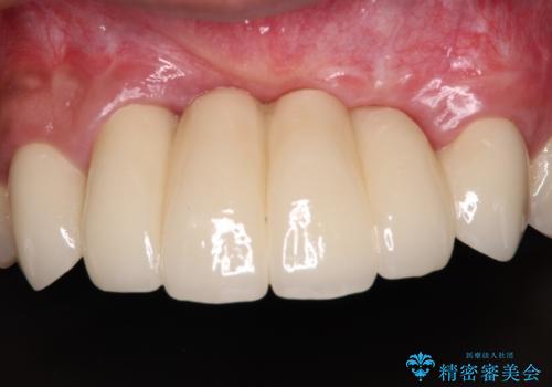 事故で抜歯となった前歯 ブリッジやインプラントによる補綴治療の治療後