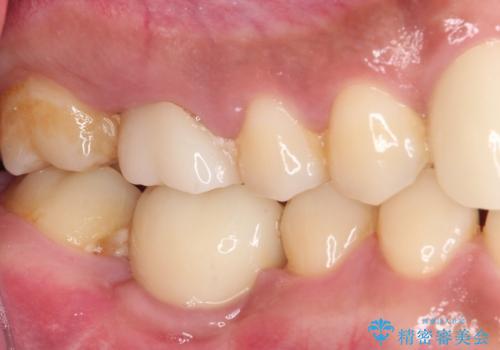 事故で抜歯となった前歯 ブリッジやインプラントによる補綴治療の治療後