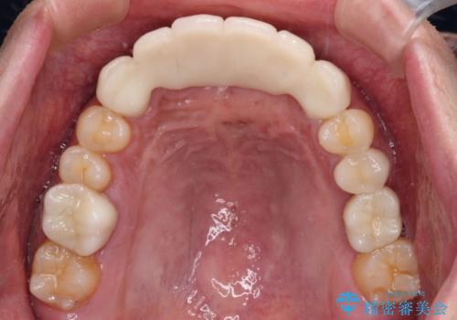 事故で抜歯となった前歯 ブリッジやインプラントによる補綴治療の治療後