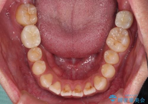 事故で抜歯となった前歯 ブリッジやインプラントによる補綴治療の治療後