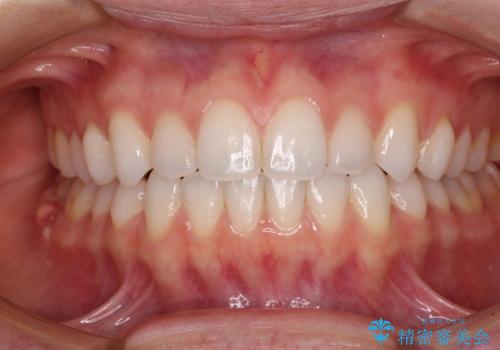 上下前歯が接触しない オープンバイトをインビザラインで改善