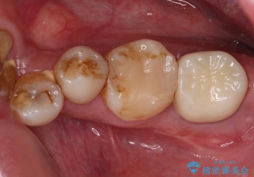セラミックは無理と言われた奥歯　フルジルコニアクラウンによる補綴治療の症例 治療後