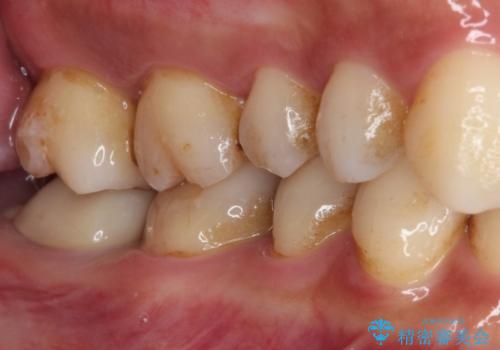セラミックは無理と言われた奥歯 フルジルコニアクラウンによる補綴治療の治療後