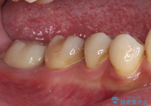 セラミックは無理と言われた奥歯 フルジルコニアクラウンによる補綴治療の治療後