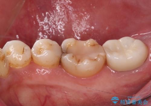 セラミックは無理と言われた奥歯 フルジルコニアクラウンによる補綴治療の治療後