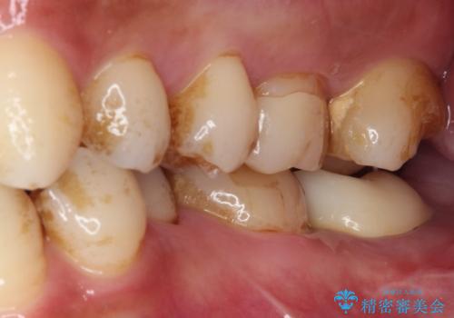 セラミックは無理と言われた奥歯 フルジルコニアクラウンによる補綴治療の治療後