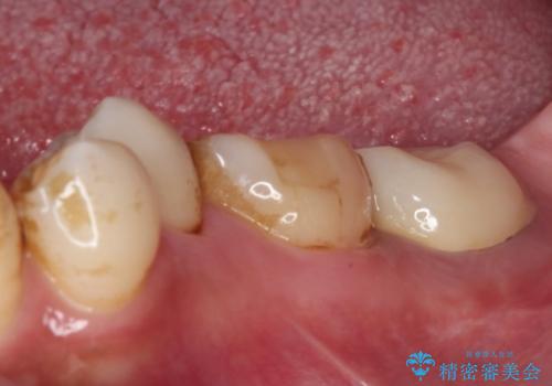 セラミックは無理と言われた奥歯 フルジルコニアクラウンによる補綴治療の治療後