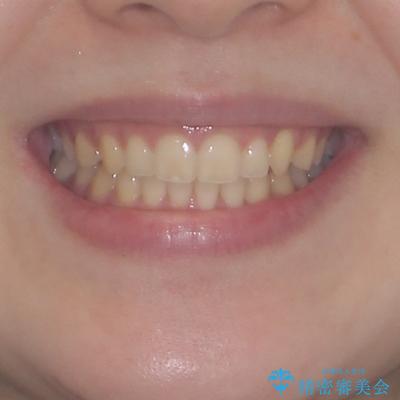気になる残存乳歯と八重歯　ワイヤー矯正を併用したインビザライン治療の治療後（顔貌）