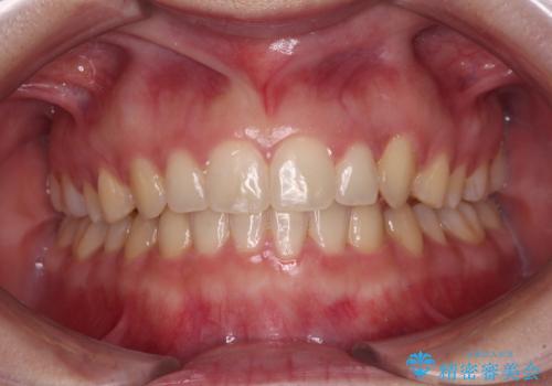 気になる残存乳歯と八重歯　ワイヤー矯正を併用したインビザライン治療の症例 治療後