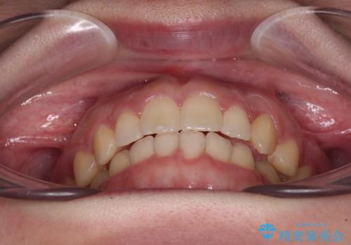気になる残存乳歯と八重歯　ワイヤー矯正を併用したインビザライン治療の治療後