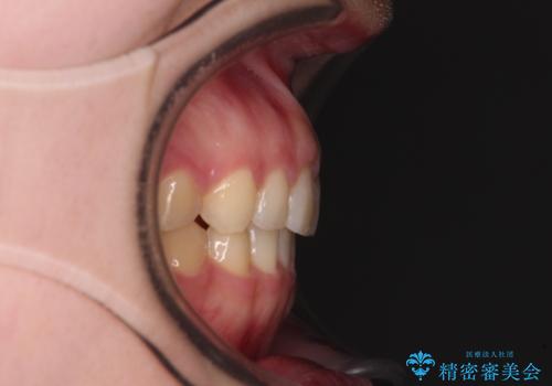 気になる残存乳歯と八重歯 ワイヤー矯正を併用したインビザライン治療の治療後