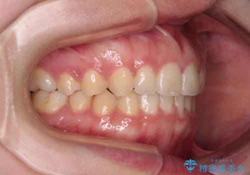 気になる残存乳歯と八重歯 ワイヤー矯正を併用したインビザライン治療の治療後