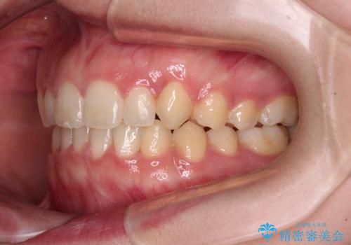 気になる残存乳歯と八重歯　ワイヤー矯正を併用したインビザライン治療の治療後