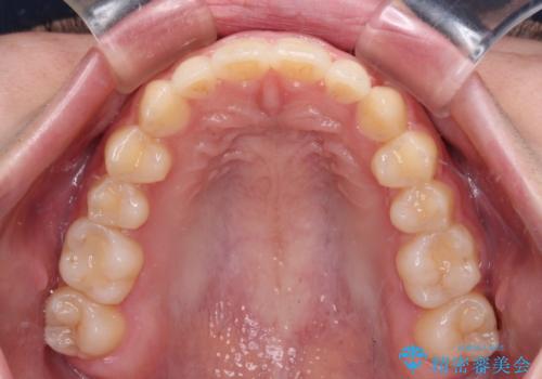 気になる残存乳歯と八重歯 ワイヤー矯正を併用したインビザライン治療の治療後