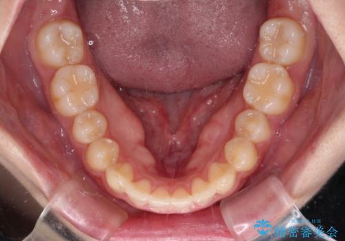 気になる残存乳歯と八重歯 ワイヤー矯正を併用したインビザライン治療の治療後