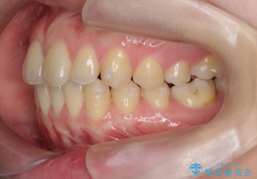 [ マウスピース矯正で前歯の改善 ]  前歯のすきっ歯を治したいの治療中