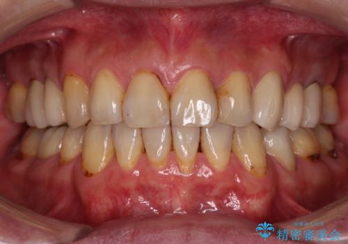 むし歯や銀歯が気になる　後戻りの再矯正治療とむし歯治療の症例 治療後