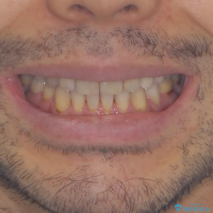 むし歯や銀歯が気になる　後戻りの再矯正治療とむし歯治療の治療後（顔貌）