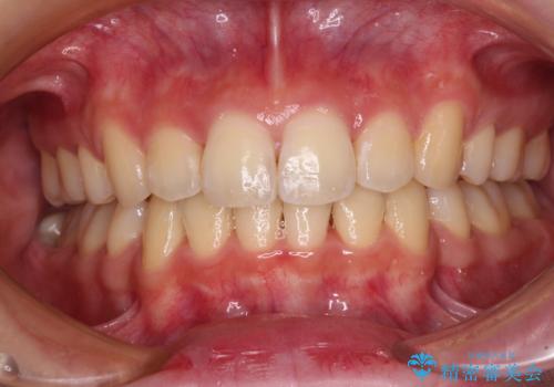 短期間で口元の突出感を改善　ワイヤー装置での抜歯矯正の症例 治療後