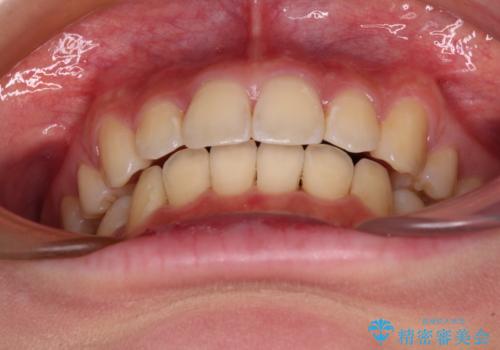 短期間で口元の突出感を改善 ワイヤー装置での抜歯矯正の治療後