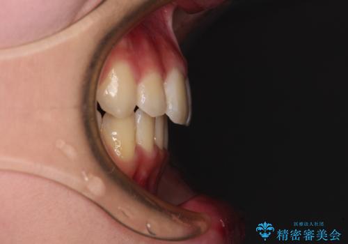 短期間で口元の突出感を改善　ワイヤー装置での抜歯矯正の治療後
