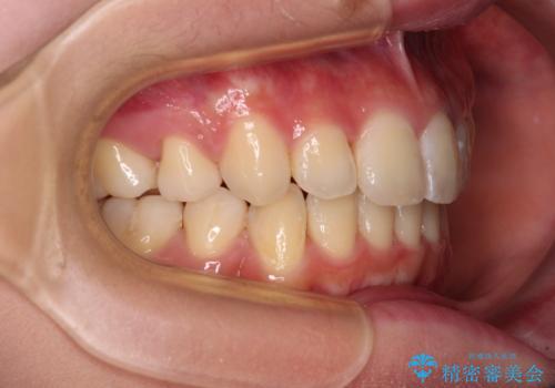 短期間で口元の突出感を改善　ワイヤー装置での抜歯矯正の治療後