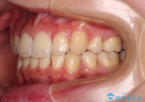 短期間で口元の突出感を改善 ワイヤー装置での抜歯矯正の治療後