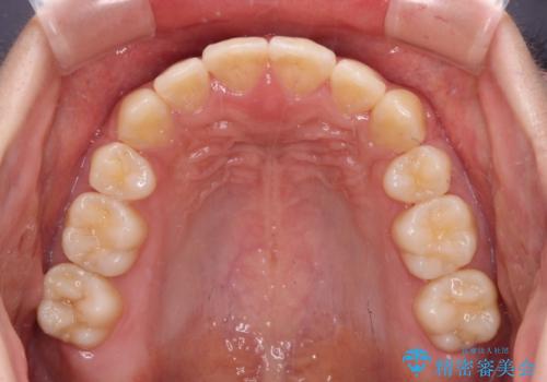 短期間で口元の突出感を改善 ワイヤー装置での抜歯矯正の治療後