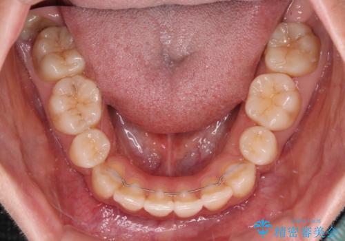 短期間で口元の突出感を改善 ワイヤー装置での抜歯矯正の治療後