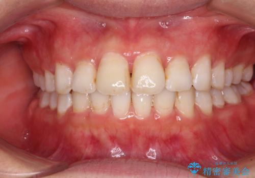 前歯の捻れを改善 インビザラインによる矯正治療の治療中