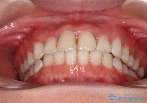 前歯の捻れを改善　インビザラインによる矯正治療の治療中