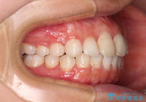 前歯の捻れを改善 インビザラインによる矯正治療の治療中