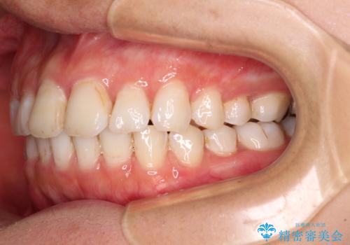 前歯の捻れを改善　インビザラインによる矯正治療の治療中