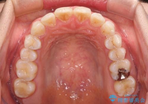 前歯の捻れを改善 インビザラインによる矯正治療の治療中