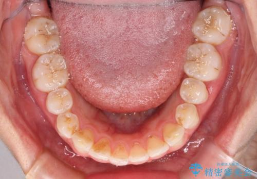 前歯の捻れを改善 インビザラインによる矯正治療の治療中