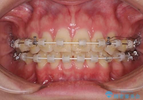 上顎前突 目立たないワイヤー装置での抜歯矯正の治療中