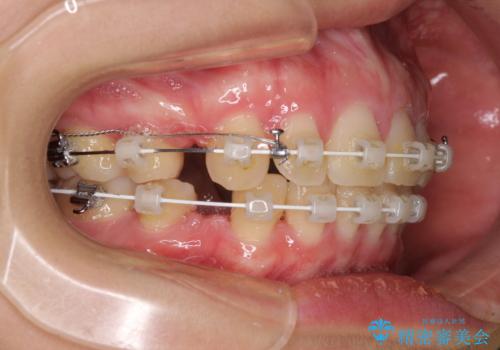 上顎前突 目立たないワイヤー装置での抜歯矯正の治療中