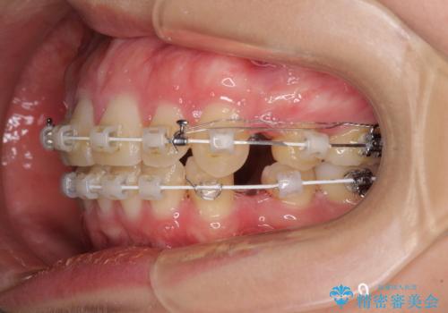 上顎前突 目立たないワイヤー装置での抜歯矯正の治療中