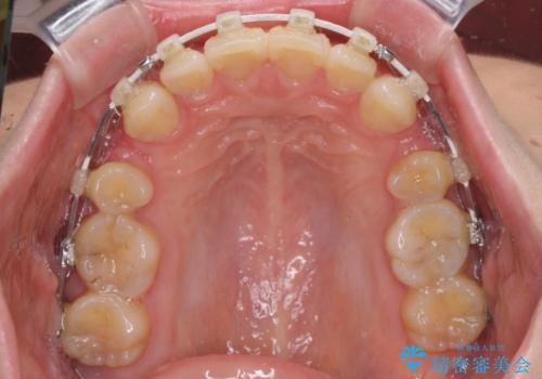 上顎前突 目立たないワイヤー装置での抜歯矯正の治療中