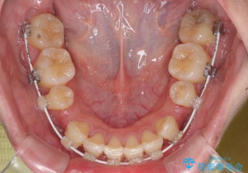 上顎前突 目立たないワイヤー装置での抜歯矯正の治療中