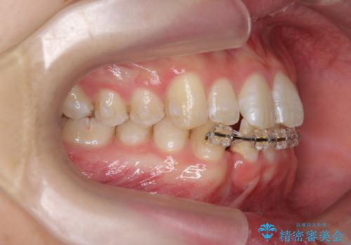クロスバイト・歯並びが原因の歯肉退縮歯、矯正治療による審美性の改善の治療中