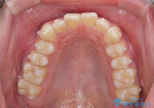 クロスバイト・歯並びが原因の歯肉退縮歯、矯正治療による審美性の改善の治療中
