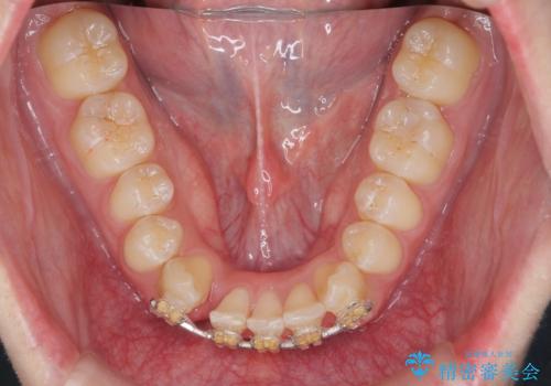 クロスバイト・歯並びが原因の歯肉退縮歯、矯正治療による審美性の改善の治療中