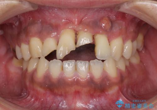事故で抜歯となった前歯　ブリッジやインプラントによる補綴治療の症例 治療前