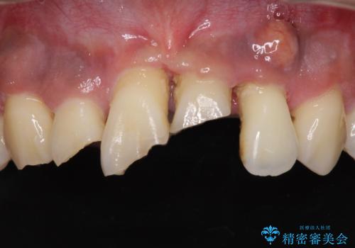 事故で抜歯となった前歯 ブリッジやインプラントによる補綴治療の治療前