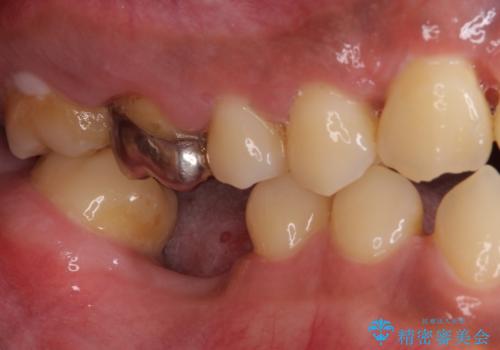 事故で抜歯となった前歯 ブリッジやインプラントによる補綴治療の治療前
