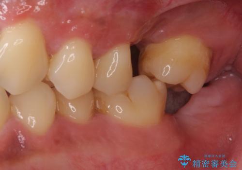 事故で抜歯となった前歯 ブリッジやインプラントによる補綴治療の治療前